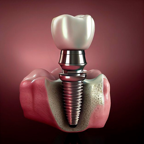 Divulgação - Coroa Sobre Implante - Foto: Divulgação