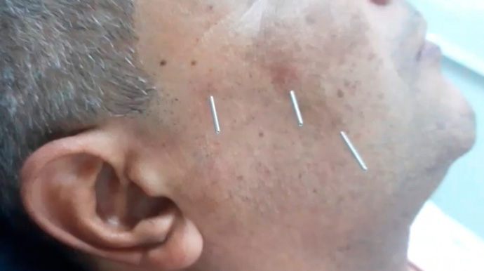 Divulgação - O Dryneedling também atua para aliviar pontos de gatilho e tensão muscular - Foto: Divulgação