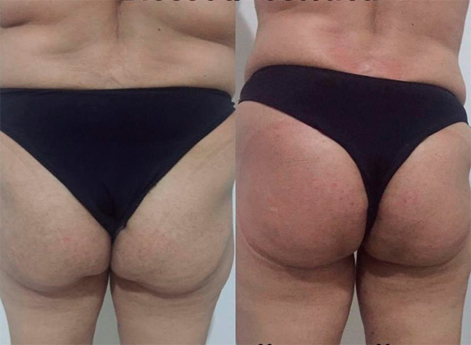 Divulgação - Confira o antes e depois do procedimento - Foto: Divulgação