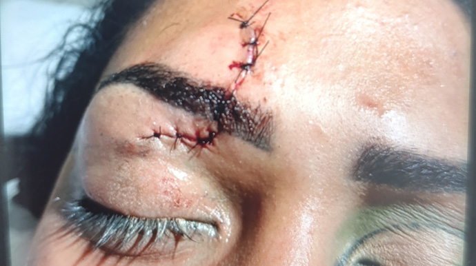 Concedida e autorizada pela vítima ao Portal AssisCity - Jovem precisou levar 12 pontos no rosto após ser agredida pelo ex-marido - FOTO: Concedida e autorizada pela vítima ao Portal AssisCity