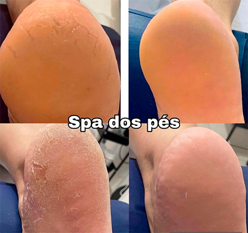 Divulgação - O Spa dos Pés oferece pés hidratados e lisinhos o tempo todo - Foto: Divulgação